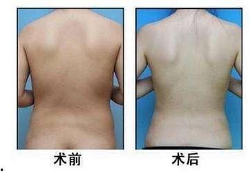 头条吸脂减肥视频可信吗,可信度几何？